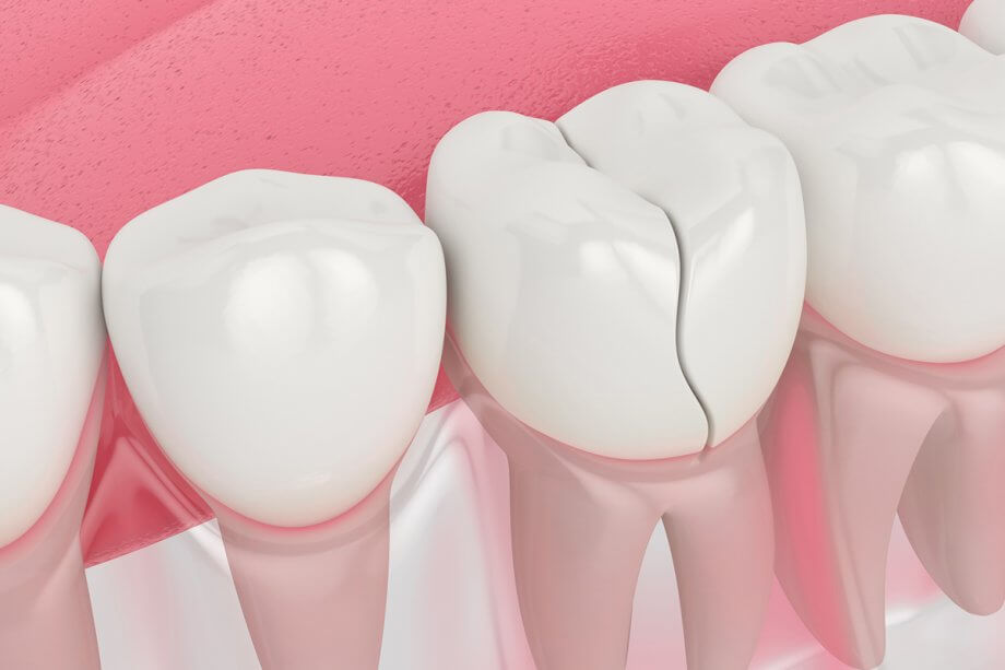 Can A Cracked Tooth Be Saved With a Dental Crown?