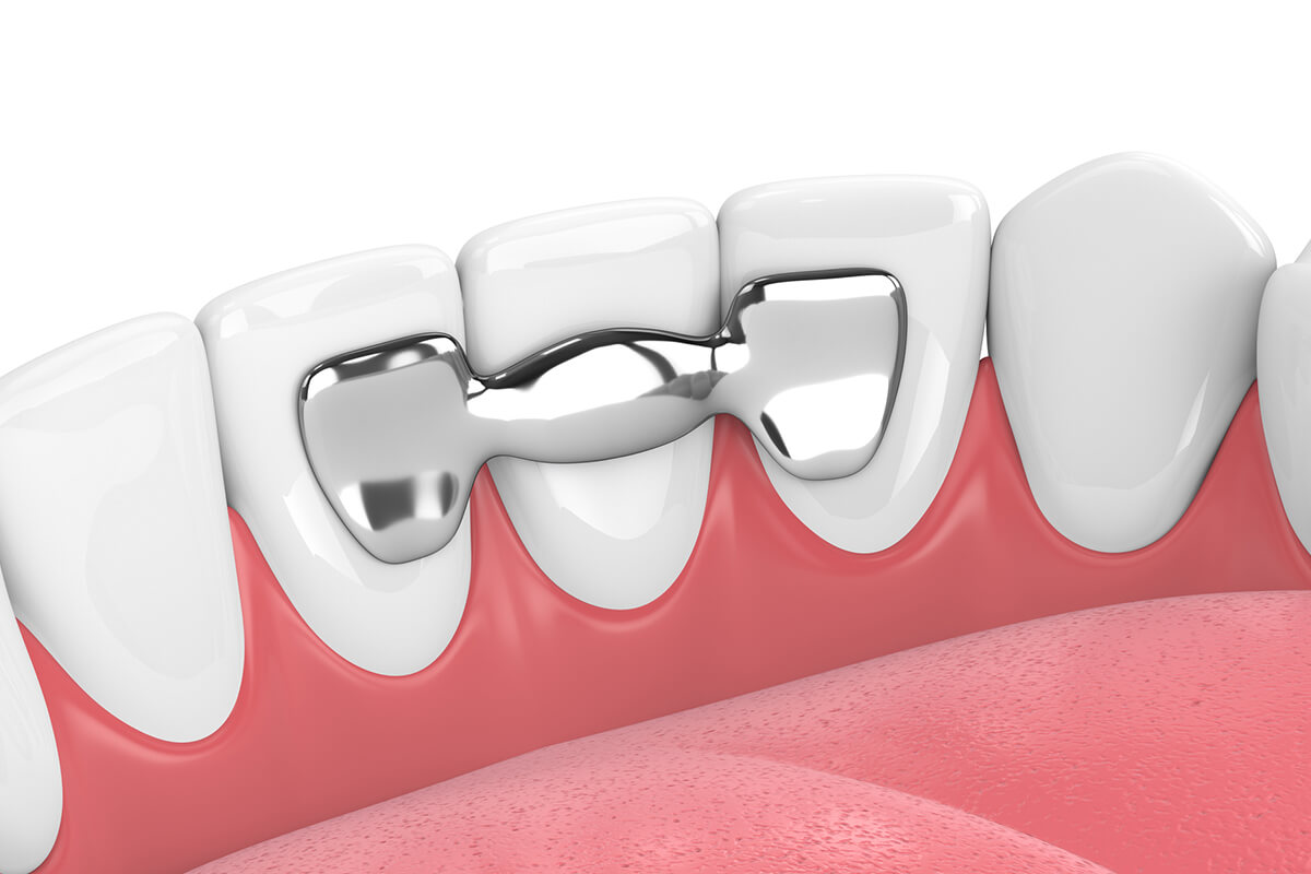 Can A Dental Bridge Be Removed And Recemented? Chagrin Falls