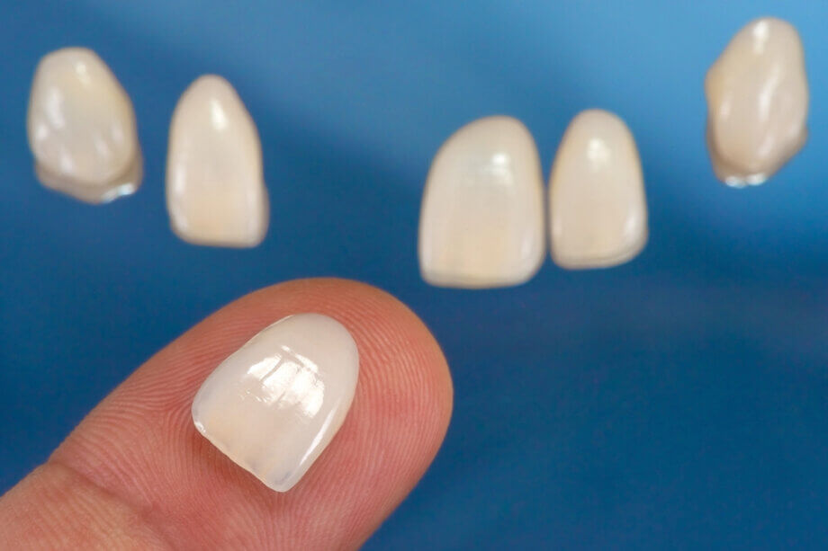 Can Veneers Fix Gaps Between Teeth?