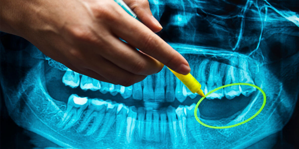 Benefits of Dental Implants in Aurora