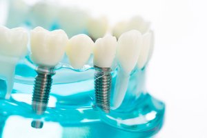 a plastic mold of teeth with two dental implants