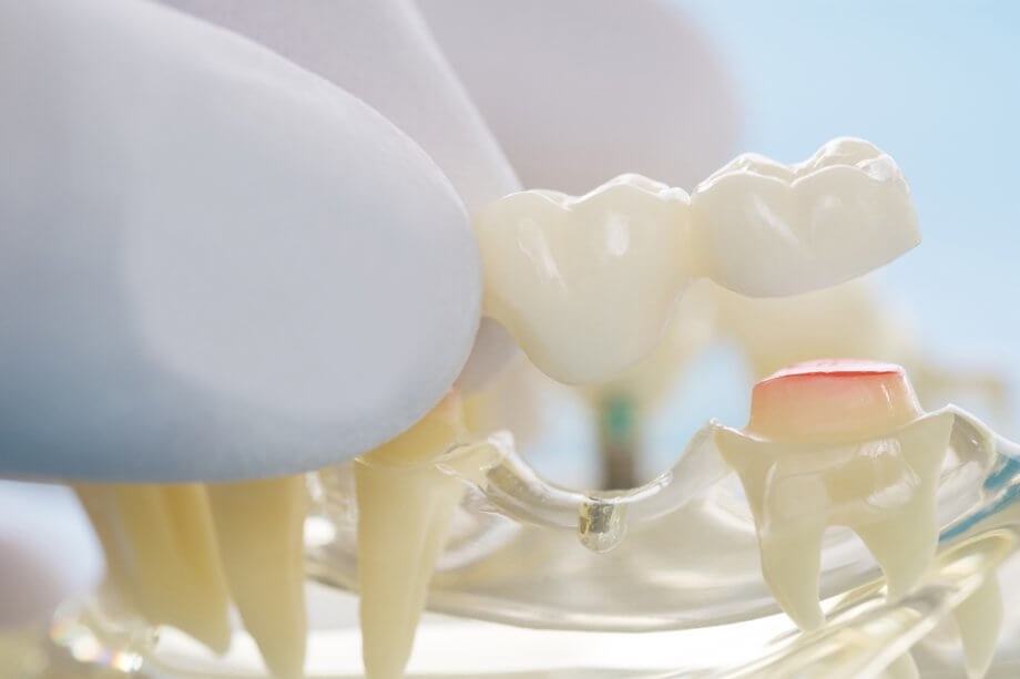 How Much Does A Dental Bridge Cost in Ohio?