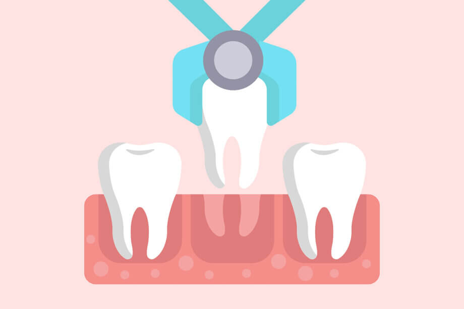 Surgical vs. Simple Tooth Extractions: What’s the Difference?